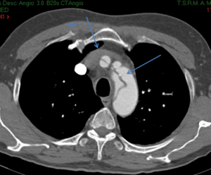 TAC: aneurisma dissecante dell'aorta interessante l'arco (freccia bassa, la succlavia e la carotide comune sin. (freccia alta). 