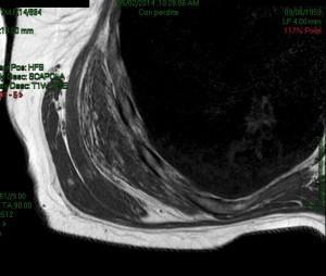 RNM senza mdc: elastofibroma dorsi dx (foto 1)