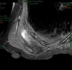 RNM con mdc: elastofibroma dorsi dx (foto 2)