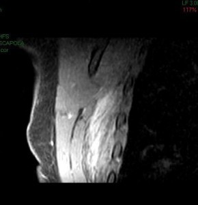 RNM con mdc: elastofibroma dorsi dx (foto 3)