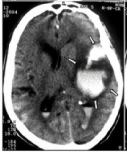 ictus emorragico (immagine RNM, da C.J.C.)