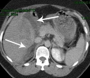 Emoperitoneo sottoepatico da trauma (TAC)