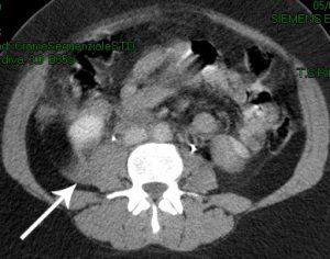 Ematoma muscolo psoas dx da trauma (TAC)