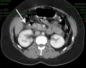 Ematoma surrenalico dx da trauma (TAC)