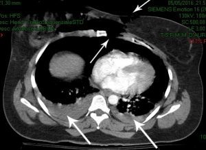 Disinserzione sternocostale paramediana sin. e versamento pleurico dx > sin. da trauma (TAC)