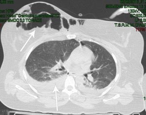 Versamento pleurico dx > sin. Pneumoseno dx traumatico (TAC)