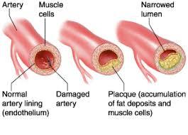 arteriosclerosi