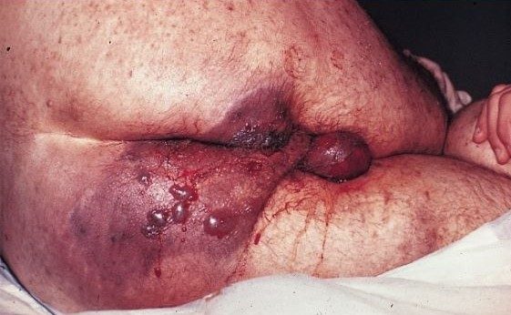 gangrena gassosa miocutanea da Clostridi interessante glutei, perineo e scroto.