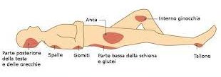 Lesioni da decubito (pressione)