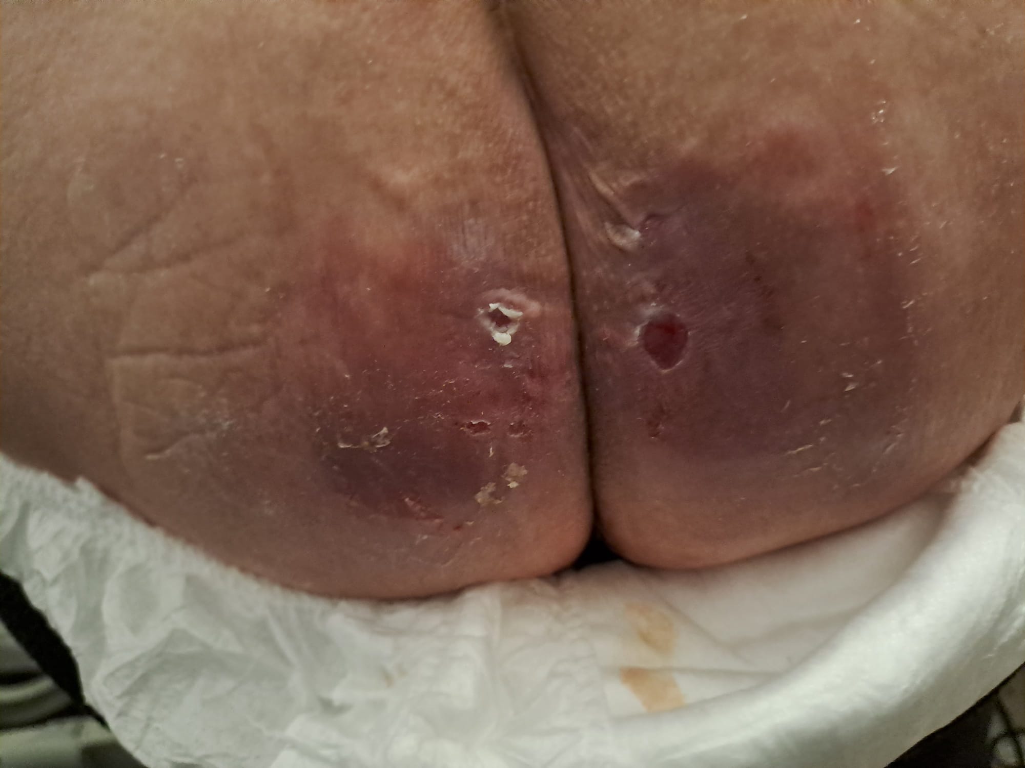 Uomo con stenosi del canale midollare, sempre seduto su sedia a rotelle con schienale incongruo. Eritema e cianosi severe glutei e sacro con 7 LDD II grado.