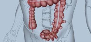 diverticolosi del colon sin. e sigma
