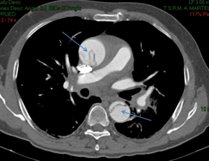 TAC: aneurisma aorta ascendente sopravalvolare (freccia alta) e discendente (freccia bassa).