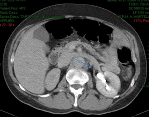 TAC: arteria renale e a. renale accessoria sin. in aneurisma dissecante aorta tipo A.