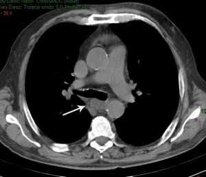 TAC: flemmone faringo-mediastinico postero-caudale dx