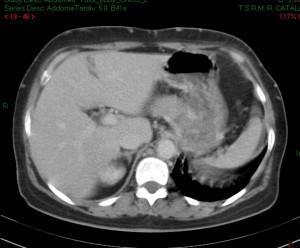 linfoma mediastinico con linfadenopatie del tripode e delle mesenteriche (immagine 4)