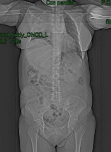 linfoma mediastinico dx: TAC toraco-addominale senza mdc (immagine 1)