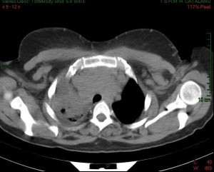 linfoma mediastinico: TAC senza mdc. Assente broncogramma aereo lobare sup. dx. Immagine 3)