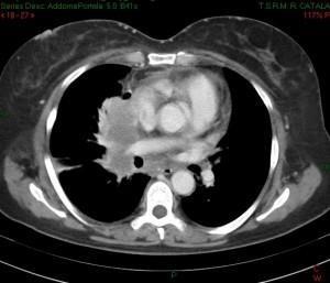 linfoma mediastinico: compressione cavale sup. e dell'aorta ascendente (immagine 2)