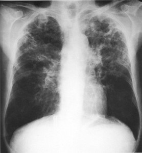 Rx TBC polmonare in fase acuta