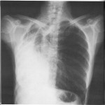 Rx carcinoma polmonare dx con atelectasia