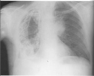 Rx microcitoma polmonare sin con fibrotorace dx (foto m.e. Sinax-Fidia)