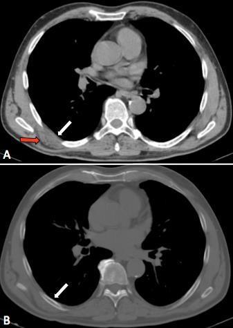 Fig. 2. Nell’immagine TC ricostruita con algoritmo per parti molli (A) si documenta una lesione a morfologia semilunare con aspetto striato localizzata al di sotto del muscolo dentato anteriore destro(freccia rossa), dalla densità simile a quella della muscolatura adiacente; da notare la lieve dislocazione del profilo pleurico (freccia bianca). Nell’immagine TC ricostruita con algoritmo per osso (B) non si apprezzano calcificazioni intralesionali né erosioni degli elementi ossei costali perilesionali (freccia).