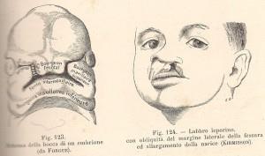 Testut e Jacob, 1906 - labbro leporino 001