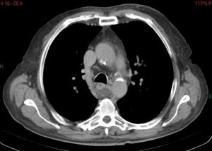 ateromasia aorta discendente e coronarica bilaterale