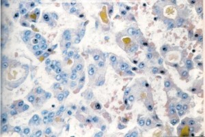 cancro del fegato, micro - foto WHO