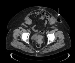 TAC: laparocele di 3.7 cm. in obesa di 70 aa. (precedente colostomia sin.) con ansa ileale nel s.c.