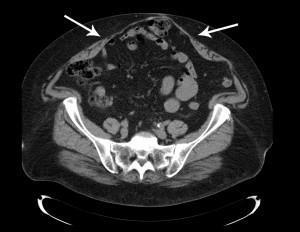 TAC: laparocele mediano sovra- sotto-ombelicale di 13.7 cm. in donna obesa di 70 aa.