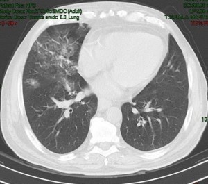 segni di polmonite dx ab ingestis (1)