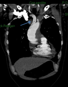 TAC: aneurisma dissecante aorta ascendente ed arco, con coinvolgimento dell'anonima dx.